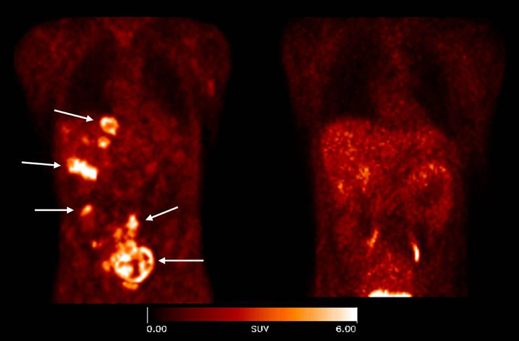avß3 integrin expression in tumors PET scan avß3 integrin expression in tumors PET scan